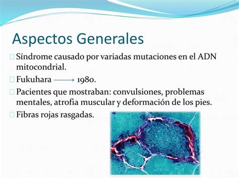 Enfermedad De Epilepsia Mioclonica Y Fibras Rojas Merrf