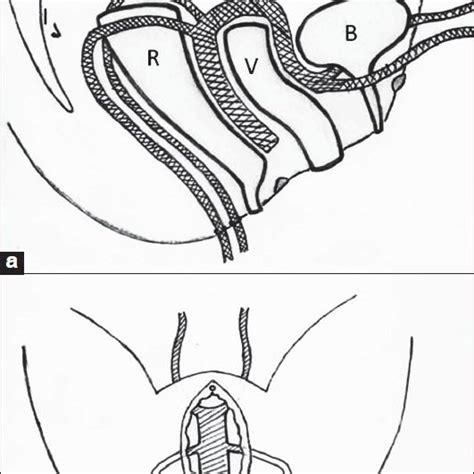 Pdf Trans Vaginal Total Pelvic Floor Repair Using Customized Prolene