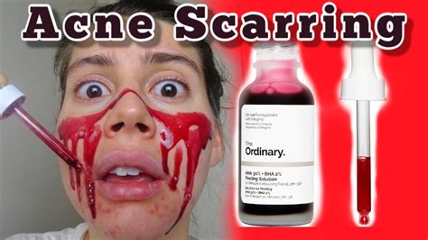 I Tested The Ordinary Peeling Solution For My Acne Scars One Month Long