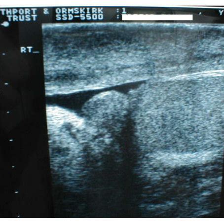 Ultrasound Of Right Side Of Scrotum The Right Testis And Epididymis