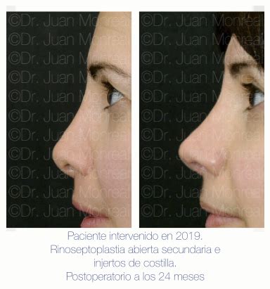 Rinoplastia implantes y rinomodelación Dr Juan Monreal