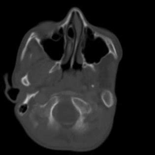 CT scan shows normal right lateral pterygoid muscle inserting along ...