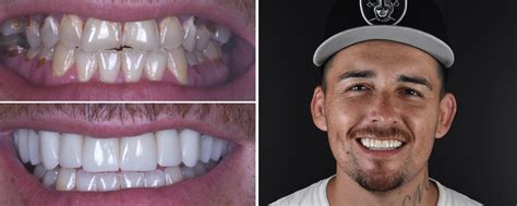 Before After Smile Makeover Gallery