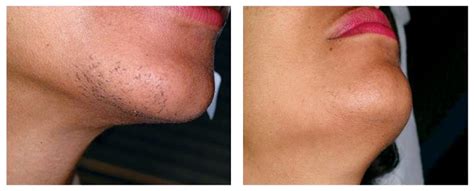 Laser Hair Removal In Houston Texas