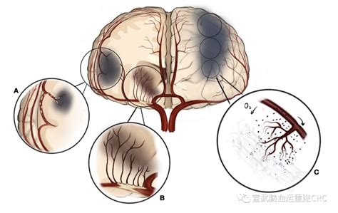 缺血性卒中的发病机制评价 脑医汇 神外资讯 神介资讯