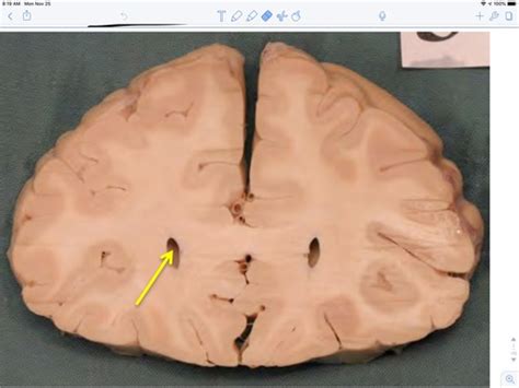 Neuroanatomy Lab Exam Cross Sections Flashcards Quizlet