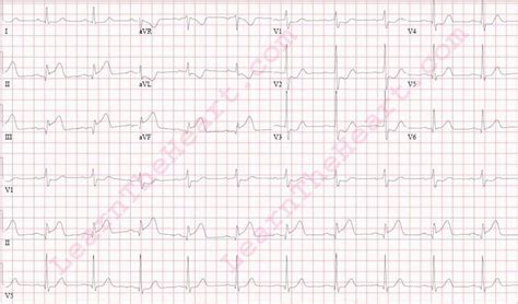 Inferior-Posterior Wall MI (Example 1) | LearntheHeart.com