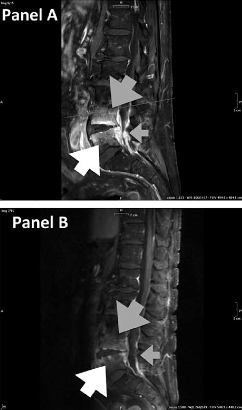 Panel A Vertebral Osteomyelitis In L Gray Arrow And L White