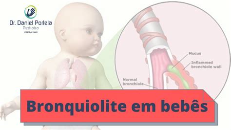 Bronquiolite Em Beb S Youtube