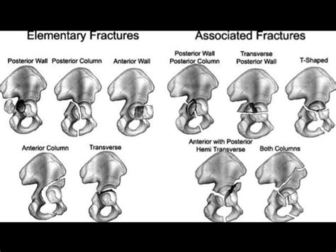 Acetabular Fracture Classification