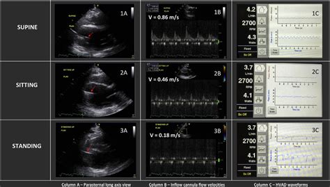 Transthoracic echocardiography showing LV size and inflow cannula ...