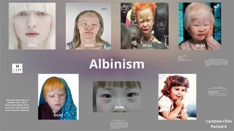 Oculocutaneous Albinism Type 3