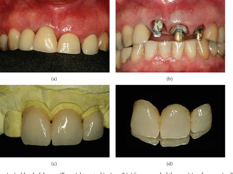 Pdf Correction Of Malpositioned Implants Through Periodontal Surgery