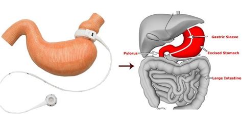 Laparoscopic Sleeve Gastrectomy Cost - Weight Loss Surgery