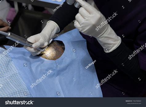 Hair Transplantation Process Pulling Hair Follicles Stock Photo Edit