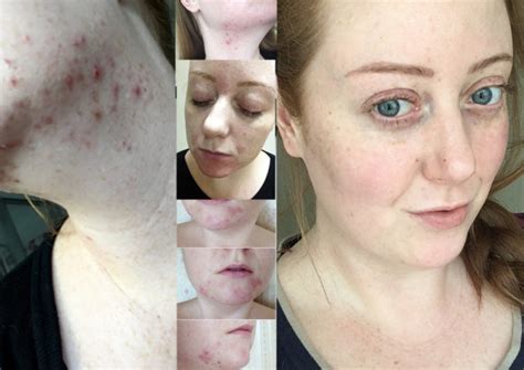 My Accutane Journey Month 5 Cuts From Crumbs And Side Effects Update