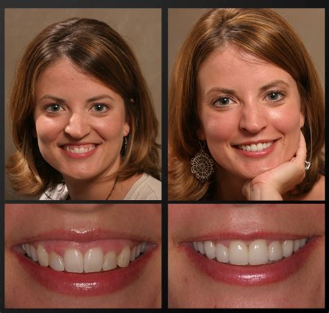 Laser Gum Treatment Rochester Mi Swollen Red Gums