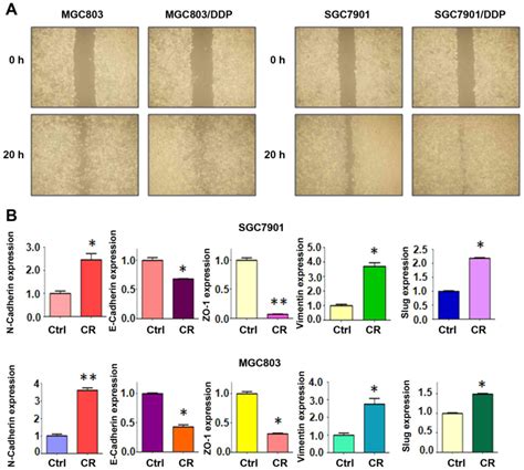 Taz Overexpression Is Associated With Epithelial Mesenchymal Transition