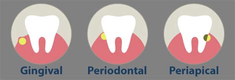 Flemón Dental Causas Y Tratamiento Del Absceso Dental Lo Que