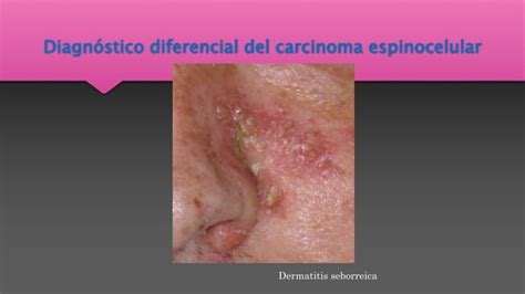 Carcinoma Basocelular Y Espinocelular Ppt