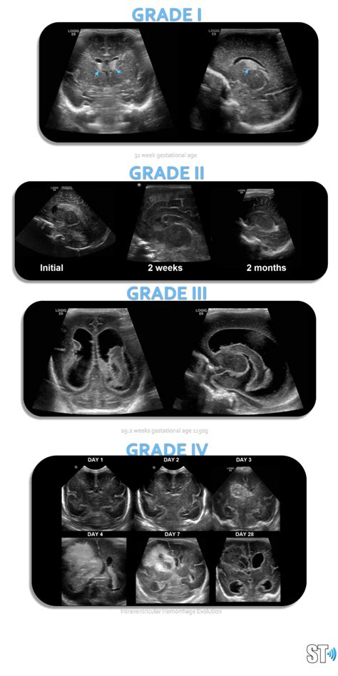 Intraventricular Hemorrhage Sonographic Tendencies