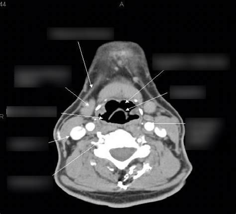 Unit 3 Neck Axial Ct Diagram Quizlet