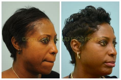 Hair Transplant African American Woman Taunyabilli