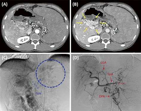 Figure2 Images Of Abdominal Computed Tomography CT A B And