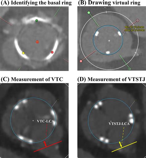 Valve In Valve Tavi And Risk Of Coronary Obstruction Validation Of The