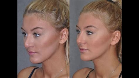 Best Rhinoplasty Nosejob Surgeon Beverly Hills Los Angeles Closed