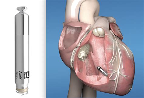 Leadless Pacemaker Technology Moves Toward Dual Chamber Pacing