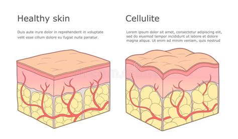 Formation Of Cellulite Stock Vector Illustration Of Bumpy 31667337