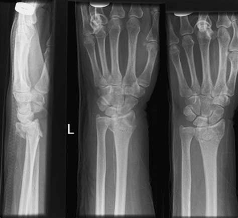 Colles’ Fracture - Pictures, Treatment, Healing Time, Surgery, Symptoms ...