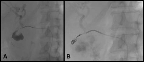 A Arteriography Showing Pseudoaneurysm Of The Gastroduodenal Artery