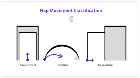 Types Classification Of Flaps