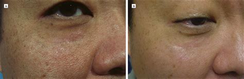 Nevus Of Ota Successfully Treated By Fractional Photothermolysis Using