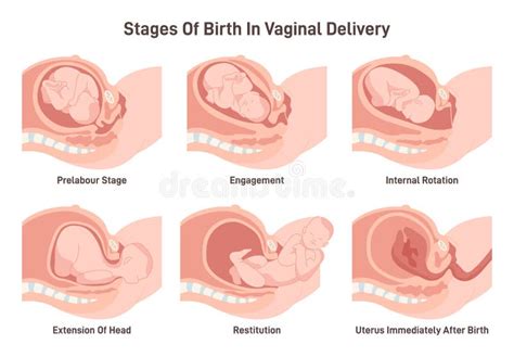 Estadios Del Parto En Parto Vaginal Movimiento Del Feto Durante El