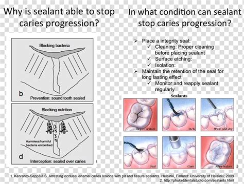 Dental Sealant Dentistry Tooth Decay Deciduous Teeth Sealing Of Pit