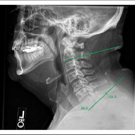 Chin Brow Vertical Angle Cbva Is Determined By Measuring A Line Drawn