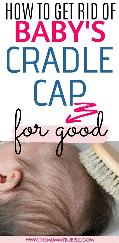 How To Get Rid Of Babys Cradle Cap For Good Baby Cradle Cap Cradle