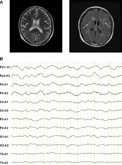 Figure1 Neuroimaging Results A Brain MRI Results On Day 3