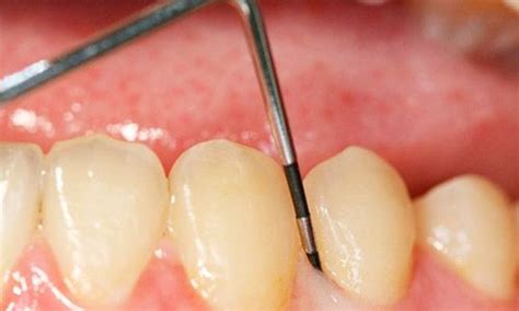 Gingivectom A En Qu Consiste Y Qu Beneficios Tiene Cl Nica