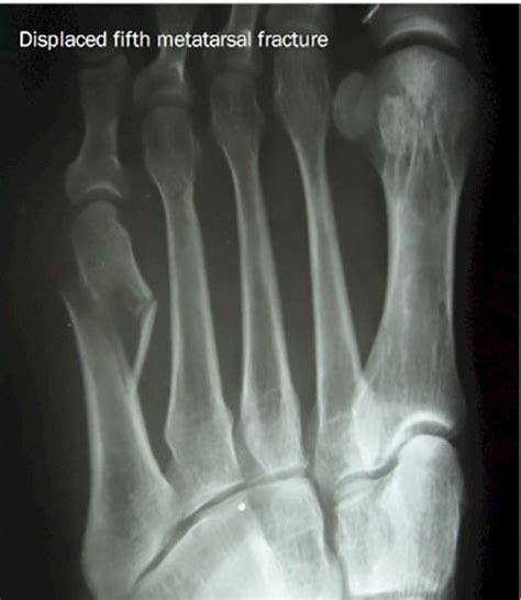 Metatarsal Fractures | Causes and treatment options | MyFootShop.com