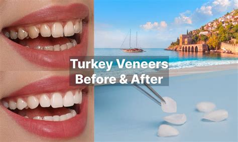 Turkey Veneers Before And After Best Results Findglob