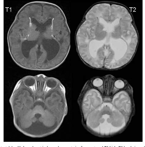 Figure 1 From Congenital Infection Like Syndrome With Intracranial