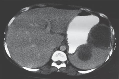 CT scan showing a large, multilocular splenic abscess | Download ...