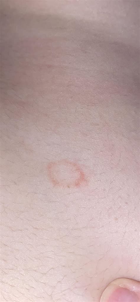 What Is This Small Circular Shaped Rash R Dermatologyquestions