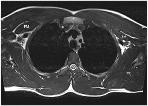 Jcm Free Full Text Mccleery Syndrome Caused By Pectoralis Minor Hypertrophy Treated With