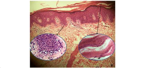 Histopathologic Examination Shows Orthokeratosis Focal Parakeratosis