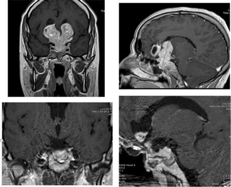 Coronal and sagittal planes from pituitary MRI of a giant prolactinoma... | Download Scientific ...